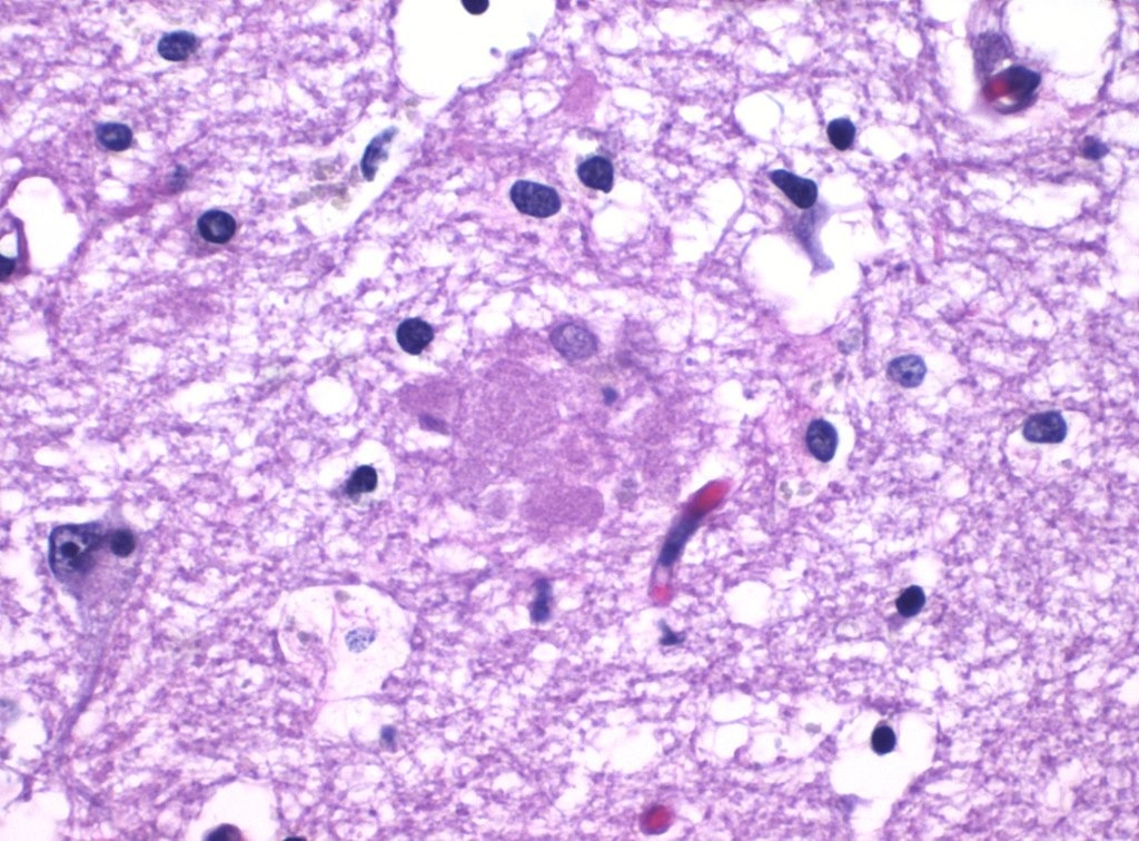 Histopathology of amyloid plaque in Alzheimer's disease Amyloid plaque in Alzheimer's disease